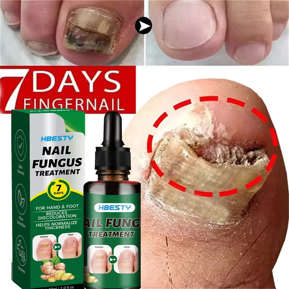 7 dni leczenie grzybicy paznokci Serum imbir antyinfekcyjny Paronychia grzybica paznokci palec u nogi paznokci grzybiczych żel naprawczy pielęgnacja dłoni i stóp