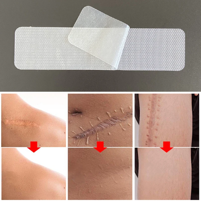 4x15cm Scar Patches Remove Silicone Gel Sheet Treatment Patch Ear Correctors Burn Wounds Efficient Surgery Scar Tape Skin Repair