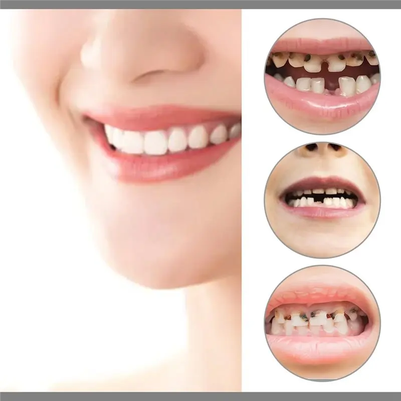 B49B-Veneers، 120 قطعة من التيجان المؤقتة لأغطية الأسنان، 70 أماميًا للأسنان + 50 قبعة أسنان خلفية، طقم إصلاح الأسنان #2