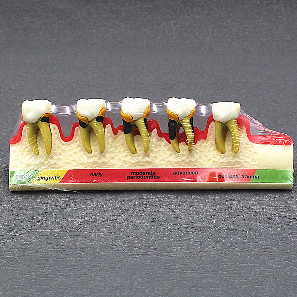 Dental Periodontal Disease Model Caries Fault Display Teaching Periodontal Model Dental Patient Communication