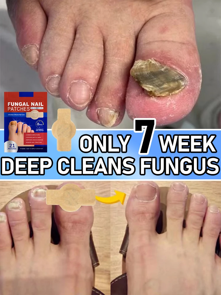 

21Pcs Toenail Fungus Patch Waterproof Nail Repair Patches Nail Ingrown Correction Sticker Discolored Damaged Nail Foot Care Tool