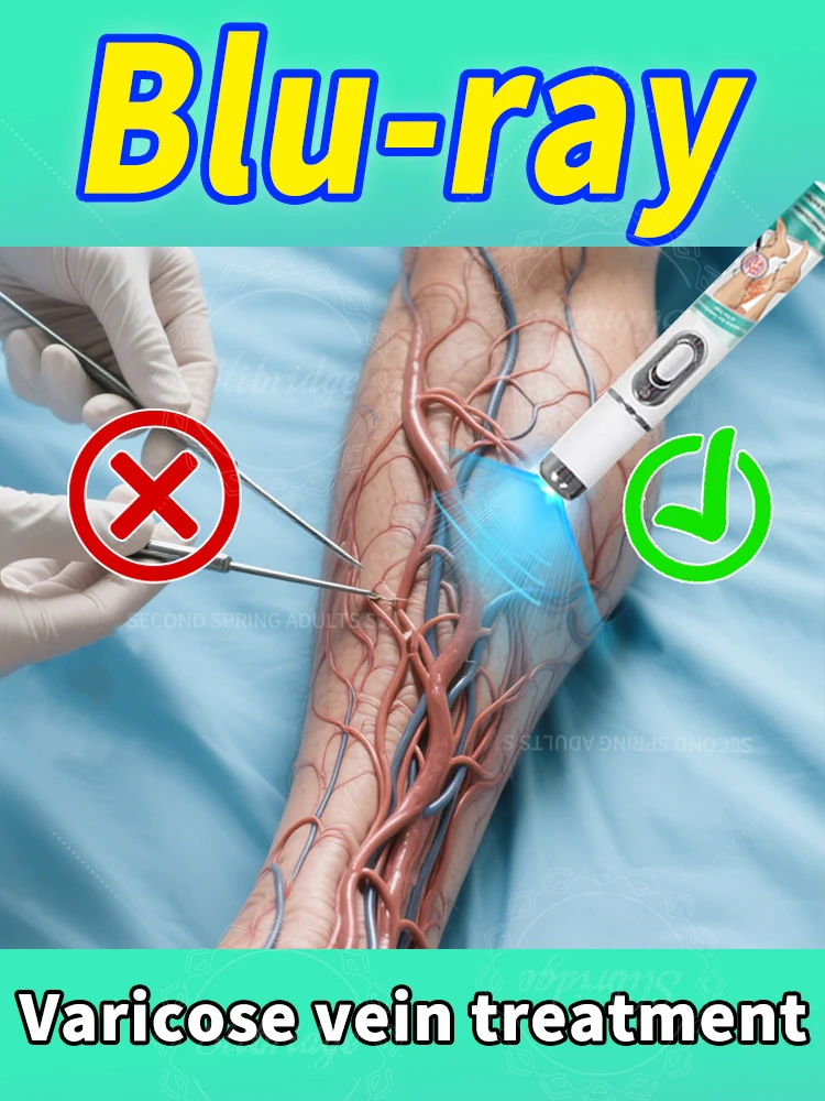 

Поколение 2: Внутреннее лазерное безболезненное лечение варикозного расширения вен