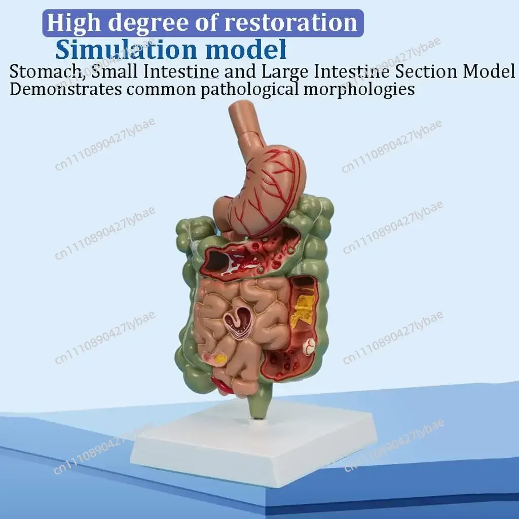Large intestine with stomach pathology model detachable teaching and research tool for human digestive system visceral structure