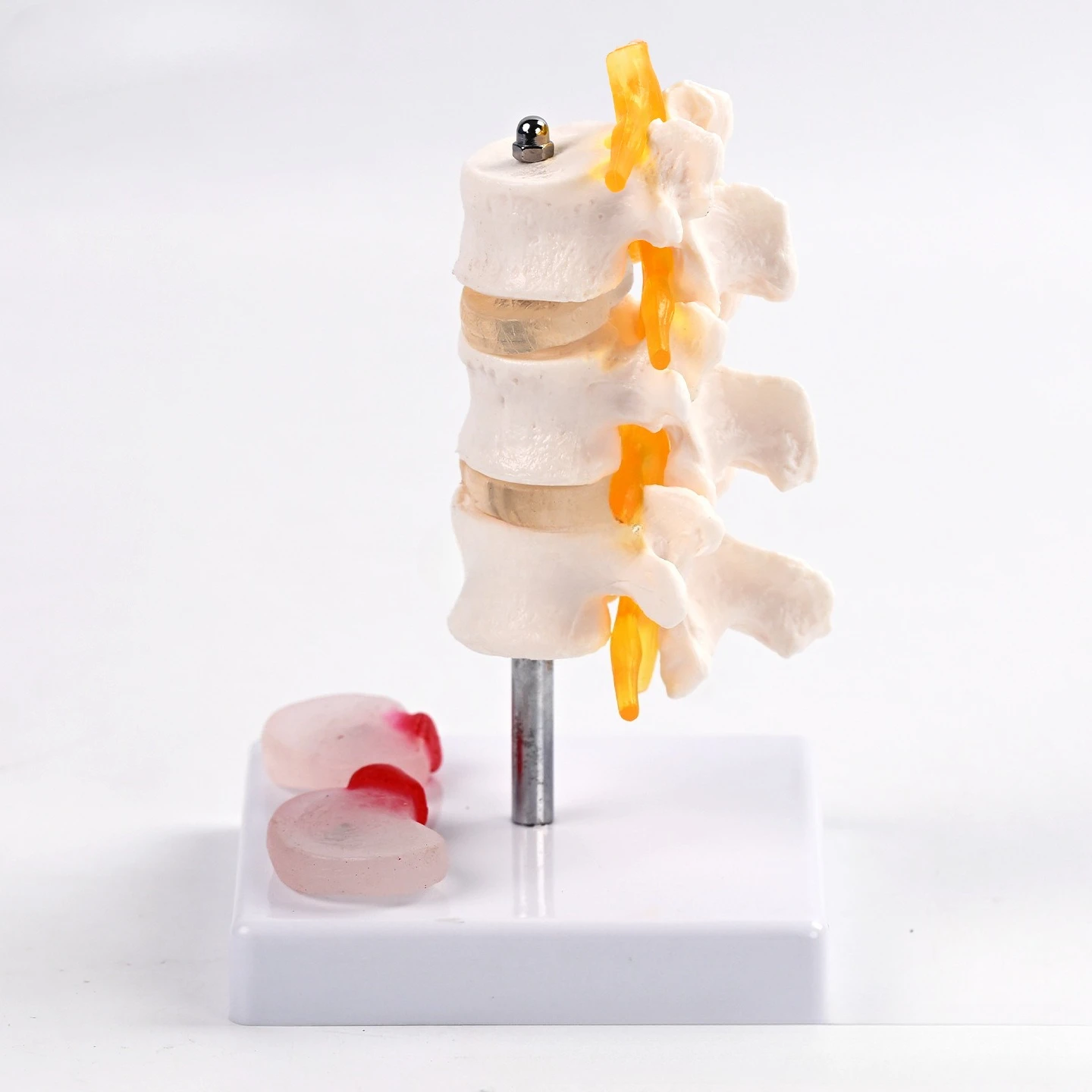 Medical intervertebral disc model of three lumbar vertebral belt lesions