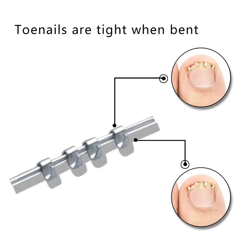 1PCS Professionelle Eingewachsene Kappe Nagel Korrektur Draht Fixer Behandlung Werkzeug Pediküre Paronychie Erholen Zehennägel Corrector Reusable