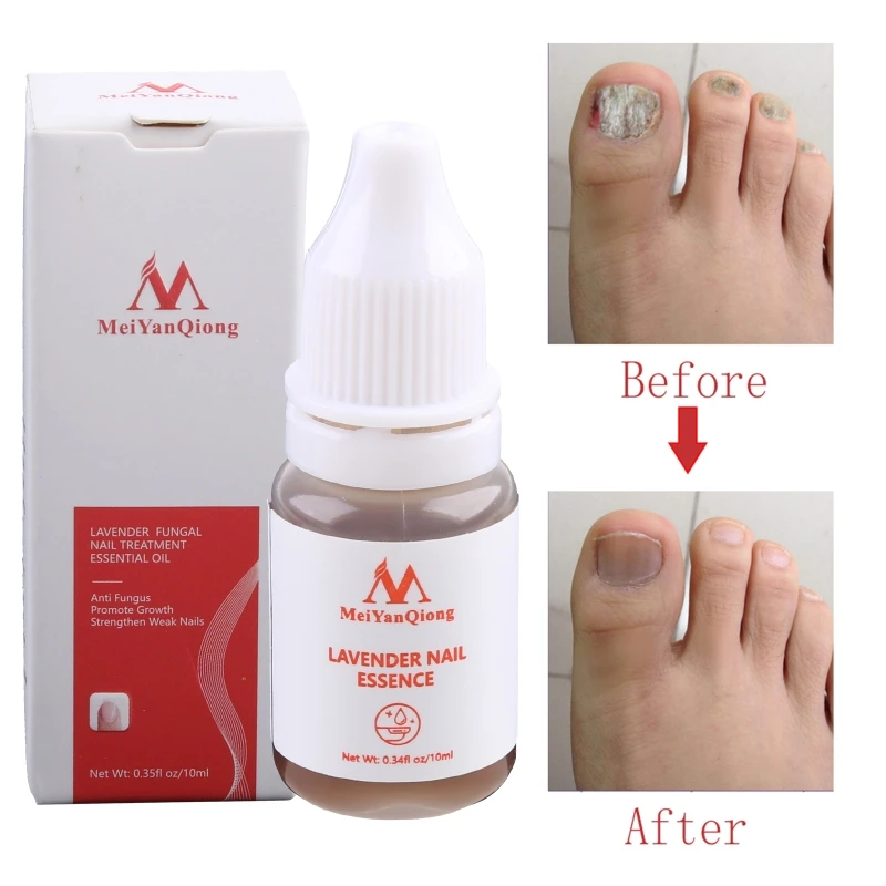 E1YE Repair Essence เซรั่มเชื้อราเล็บ Onychomycosis กำจัดเล็บ