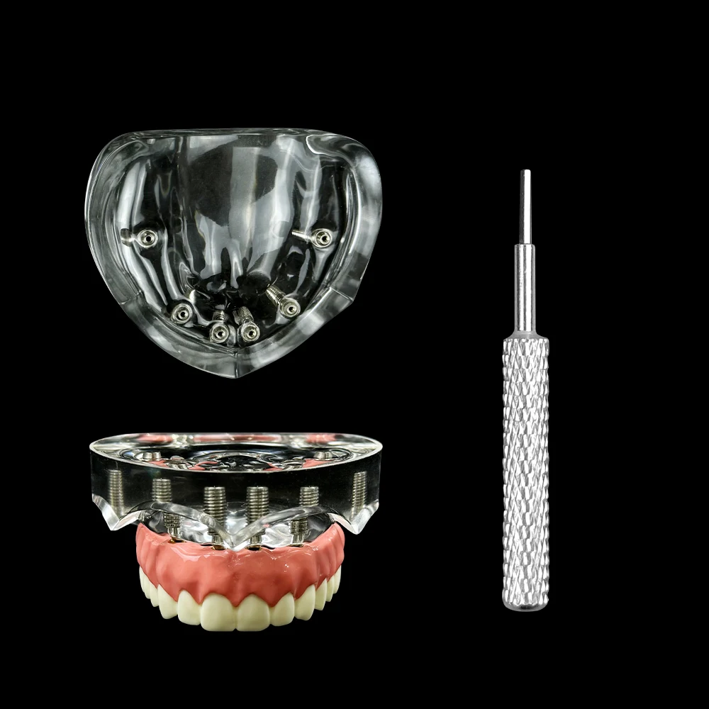 

Dental Model Implant Restoration Model Maxillary Removable Overdenture Model With 6 Implants Dentist Students Education Model