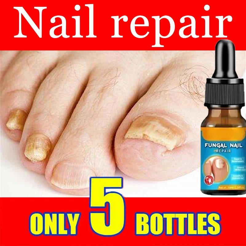 Nail Fungal Treatment Feet Care Essence Anti Infection Paronychia Onychomycosis Nail Foot Toe Nail Fungus Removal Gel Products