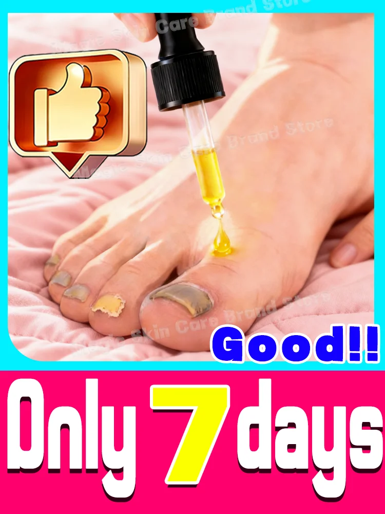 Eʟɪᴍɪɴᴀᴛᴇ ғᴜɴɢᴀʟ ɴᴀɪʟs Rapid penetration, restoring nails to their natural shine. Say goodbye to fungal nails