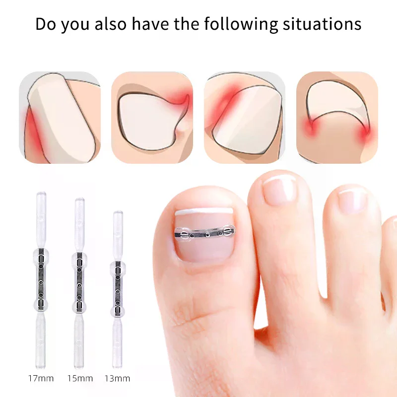 Autocollants de Correction des ongles incarnés élastiques, 2 pièces, patchs auxiliaires invisibles, traitement Paronychia, récupération