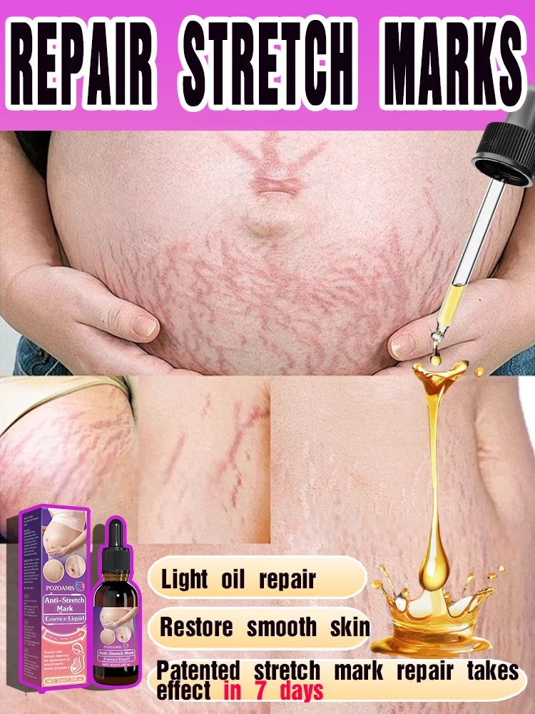 

Say goodbye to the trouble of stretch marks, start with choosing the right products
