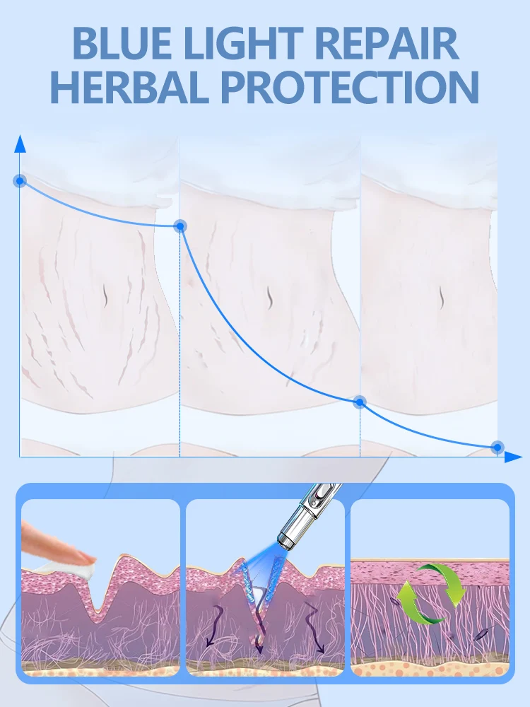 Envío gratis, ayuda a personas con estrías, resuelve sus problemas y sin problemas, herramienta de bolígrafo con luz azul