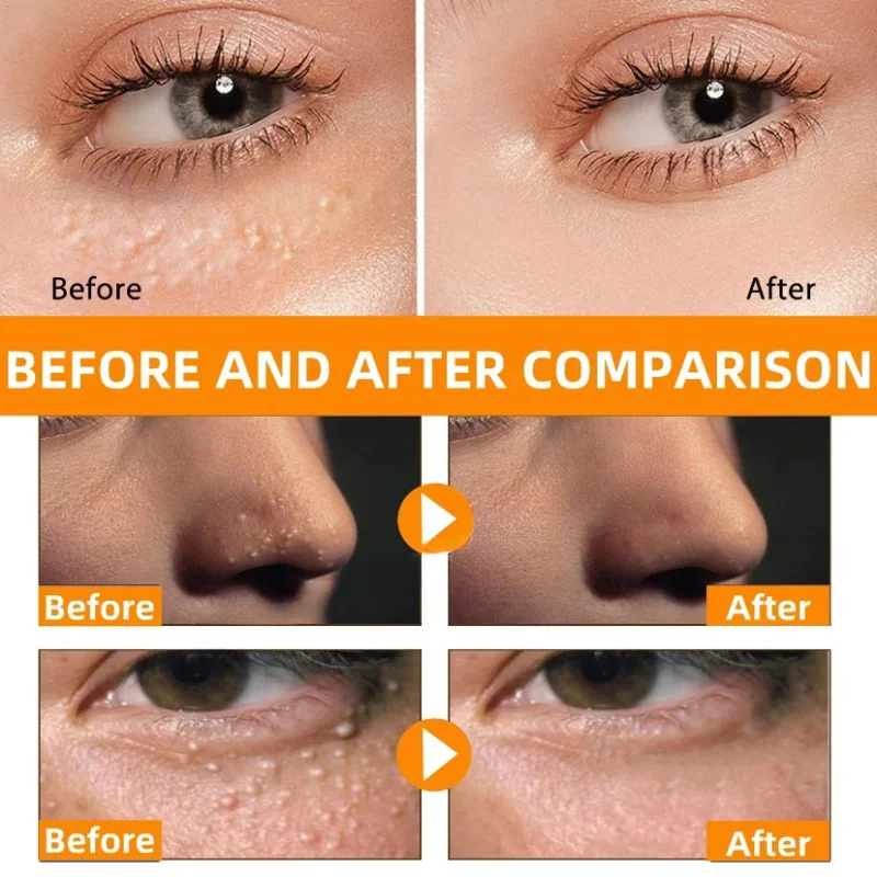 Fat Granules Removal Eye Serum Anti Dark Circle Eye Bags Fade Fine Line Essence Anti-Puffiness Moisturizing Skin Care Products