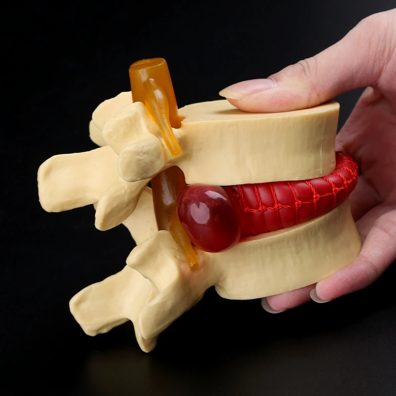 Modelo de enseñanza de hernia Lumbar, Anatomía Humana, esqueleto, columna vertebral, vértebra, modelo de demostración de Patología