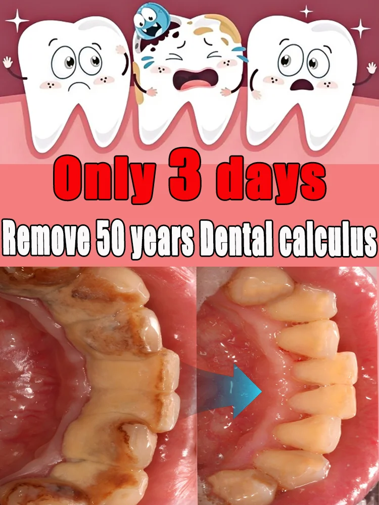 

Dental Calculus Removes Yellow Teeth Stains Fresh Breath Care