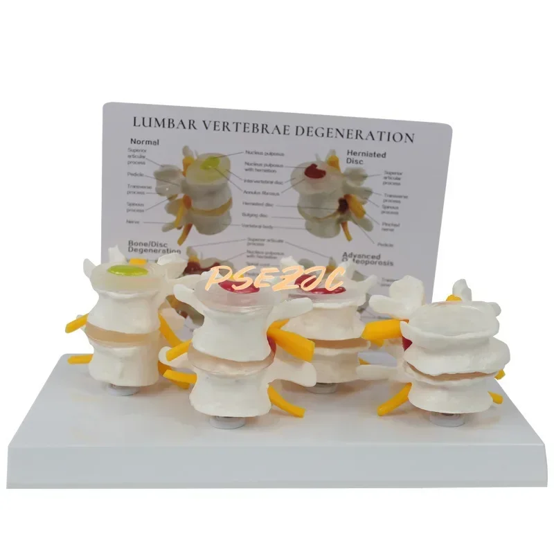 Stage 4 Pathology Lumbar Spine Human Model Orthopedic Teaching Demonstration Assisted Demonstration Teaching (with Back Card)