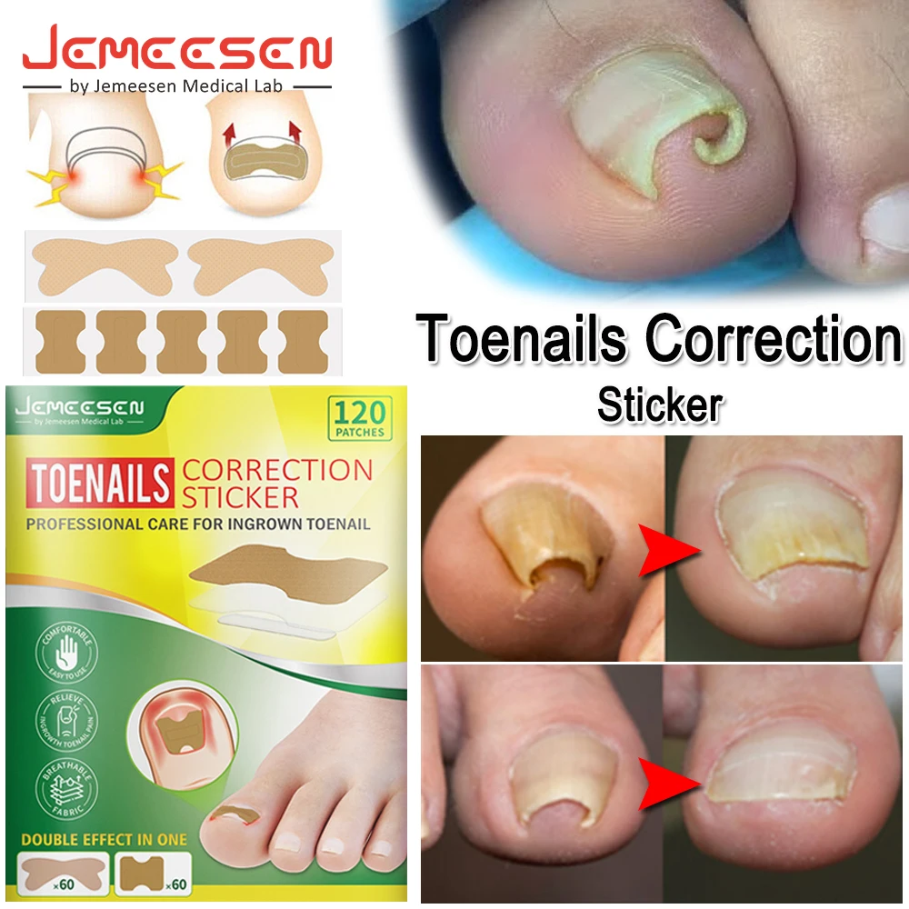 

Jemeesen Nail Correction Stickers Ingrown Toenail Corrector Patches Treatment Recover Corrector Pedicure Big Toe Nail Patch