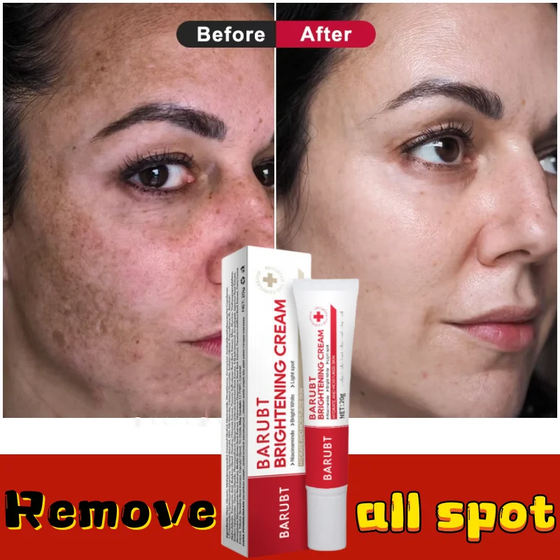 

Whitening Freckles Face Cream Removal Melasma Dark Spots Corrector Lighten Melanin Pigmentation Brighten Anti-Aging Beauty Care