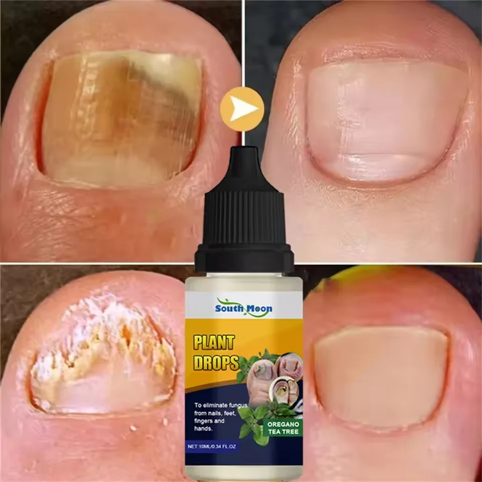 

7 DAYS Nail Fungus Treatments Liquid Serum Anti-Infection Onychomycosis Paronychia Hand Care Nails Foot Fungal Removal Gel 10ml