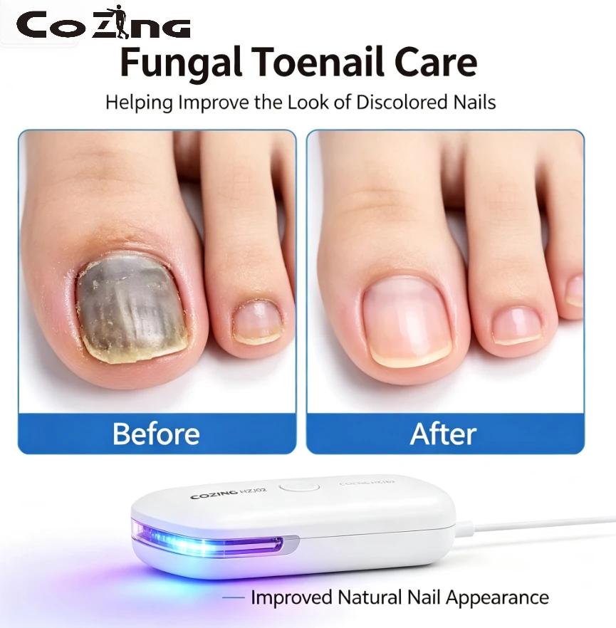 Effectively Remove Toenail Fingernail Fungus – Onychomycosis Therapy Cure Machine, Nail Fungus Laser Treatment Device Repair