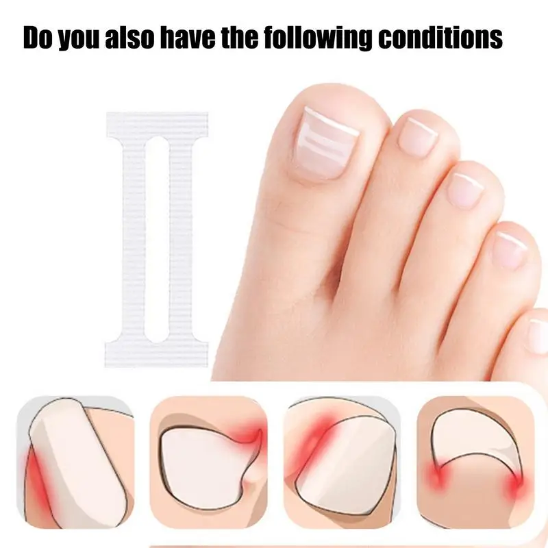 10 pçs tratamentos de unhas encravadas ferramenta de correção de unhas encravadas adesivo de remendo elástico ferramenta de correção de unhas encravadas