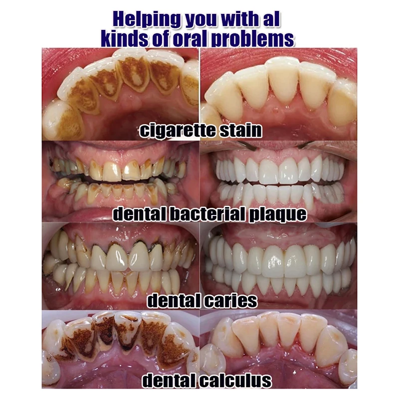 Средство для удаления зубного налета, отбеливание зубов, удаление запаха полости рта, уменьшение зубного налета, раньше, профилактика пародонтита, уход за полостью рта