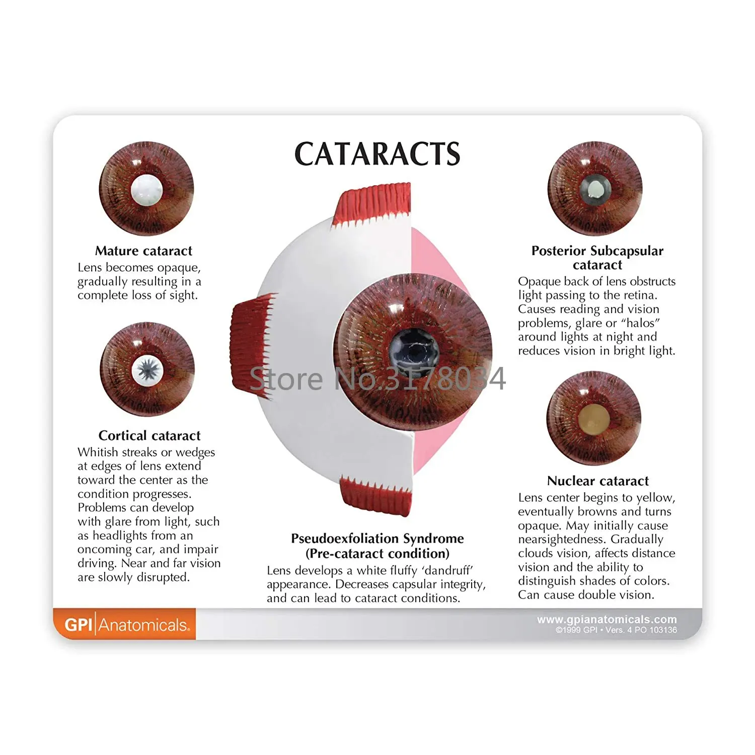 Human Cataract Eye Anatomical Model Body Anatomy Replica of Normal Eye for Doctors Office Educational Tool