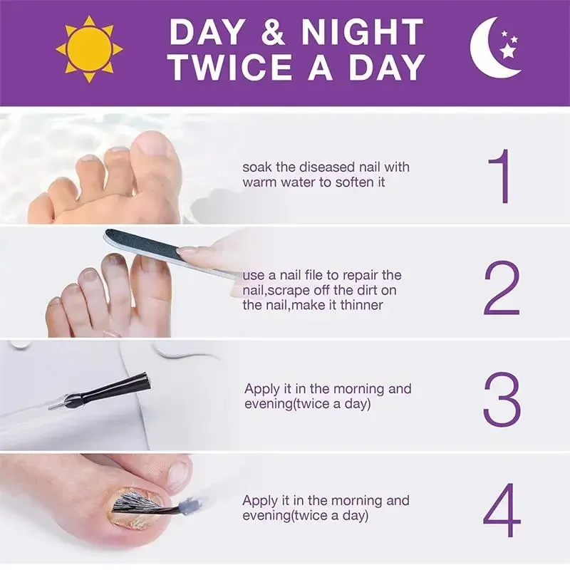 مصل علاج الأظافر الفطرية، علاج إزالة فطريات الأظافر، سائل الداحس، مضاد للأظافر الرمادية، أدوات العناية بإصلاح القدم