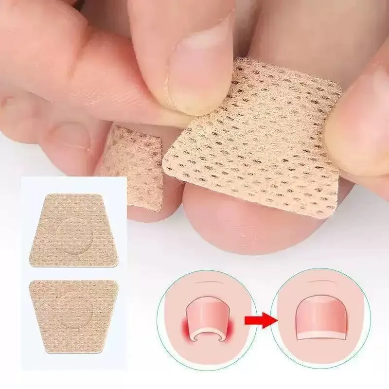 50pcs Toe Correction Patches – Repair patches for discolored or damaged nails and correction patches for ingrown nails.