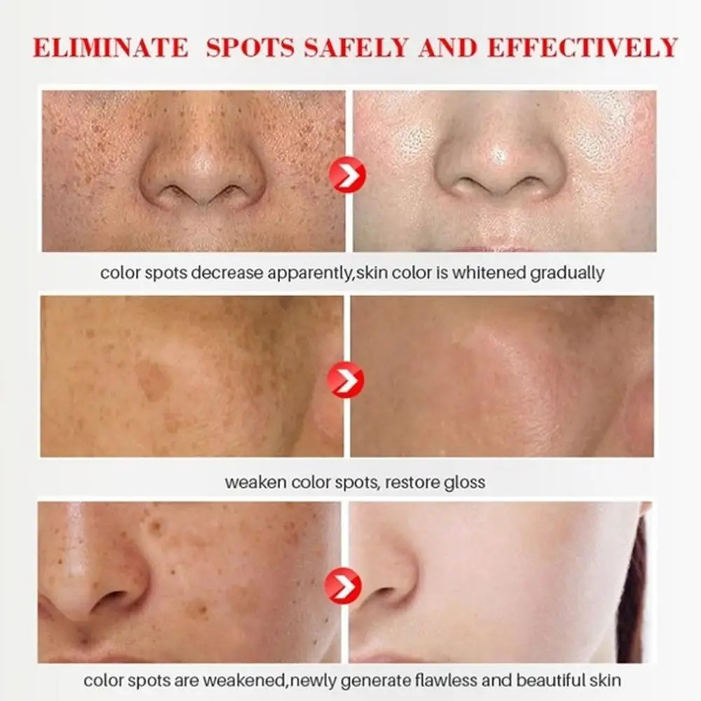 Effective Whitening Freckle Cream Remove Dark Spots Anti Freckle Cream Fade Pigmentation Melasma Brighten Creams Skin Care 20g