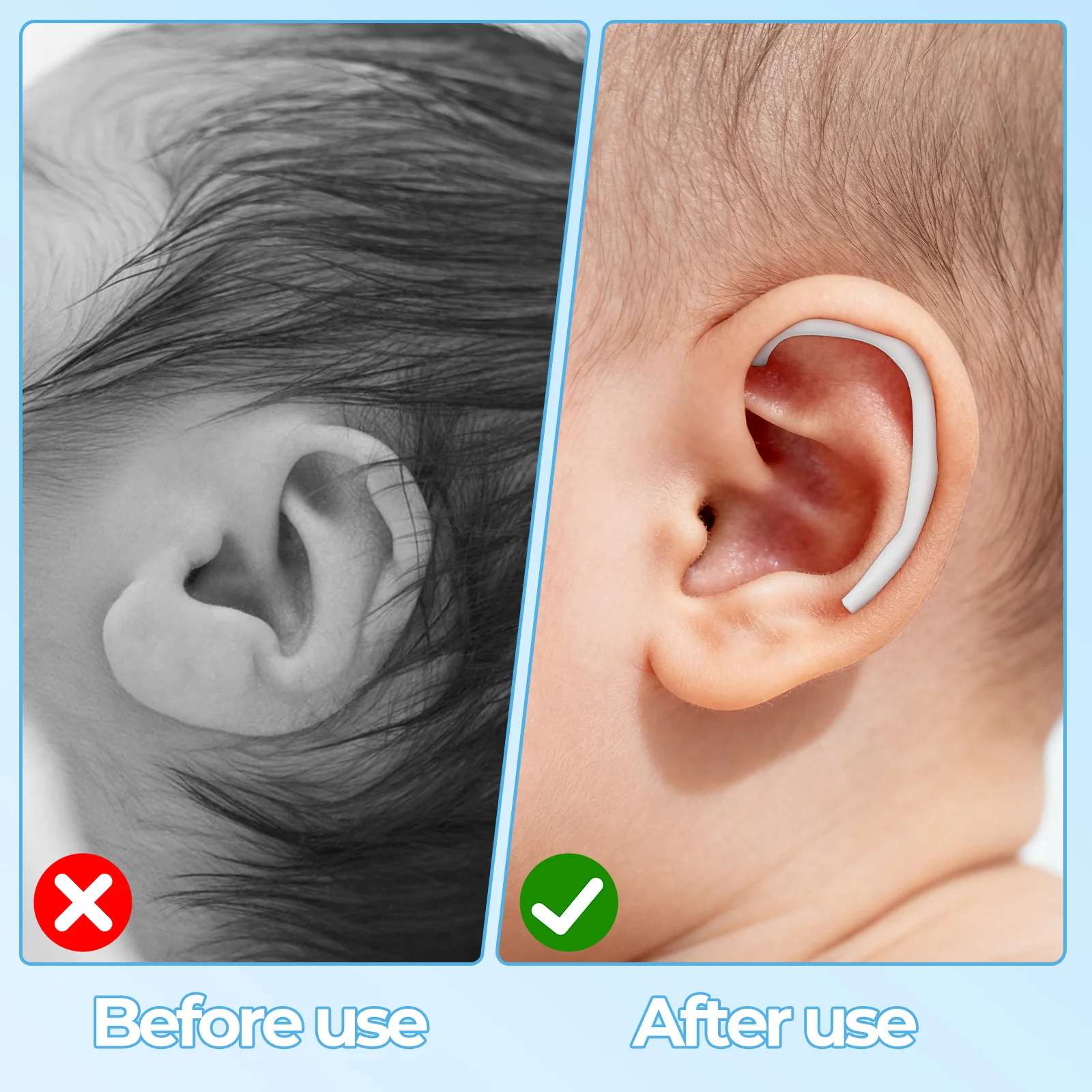مجموعة واحدة من رقعة أذن الطفل بتصميم خاص للأطفال، مصحح الأذن المتين، أداة دعم مادة السيليكون المتينة، شريط أذني الطفل #4
