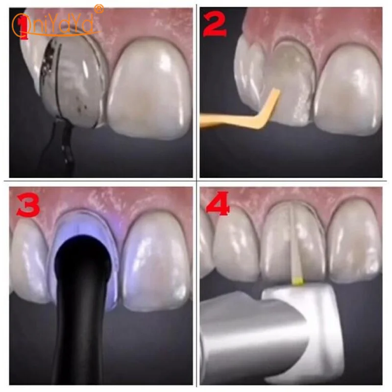 1 zestaw fornir dentystyczny pudełko formy żywica kompozytowa utwardzane światłem przednie zęby szybkie narzędzie dentystyczne