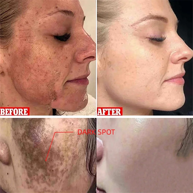 

Reduce Dullness Acne Marks Face Cream Rejuvenating Creams Brightening Whitening Hydrating Gloss Skincare Beauty Korean Cosmetics