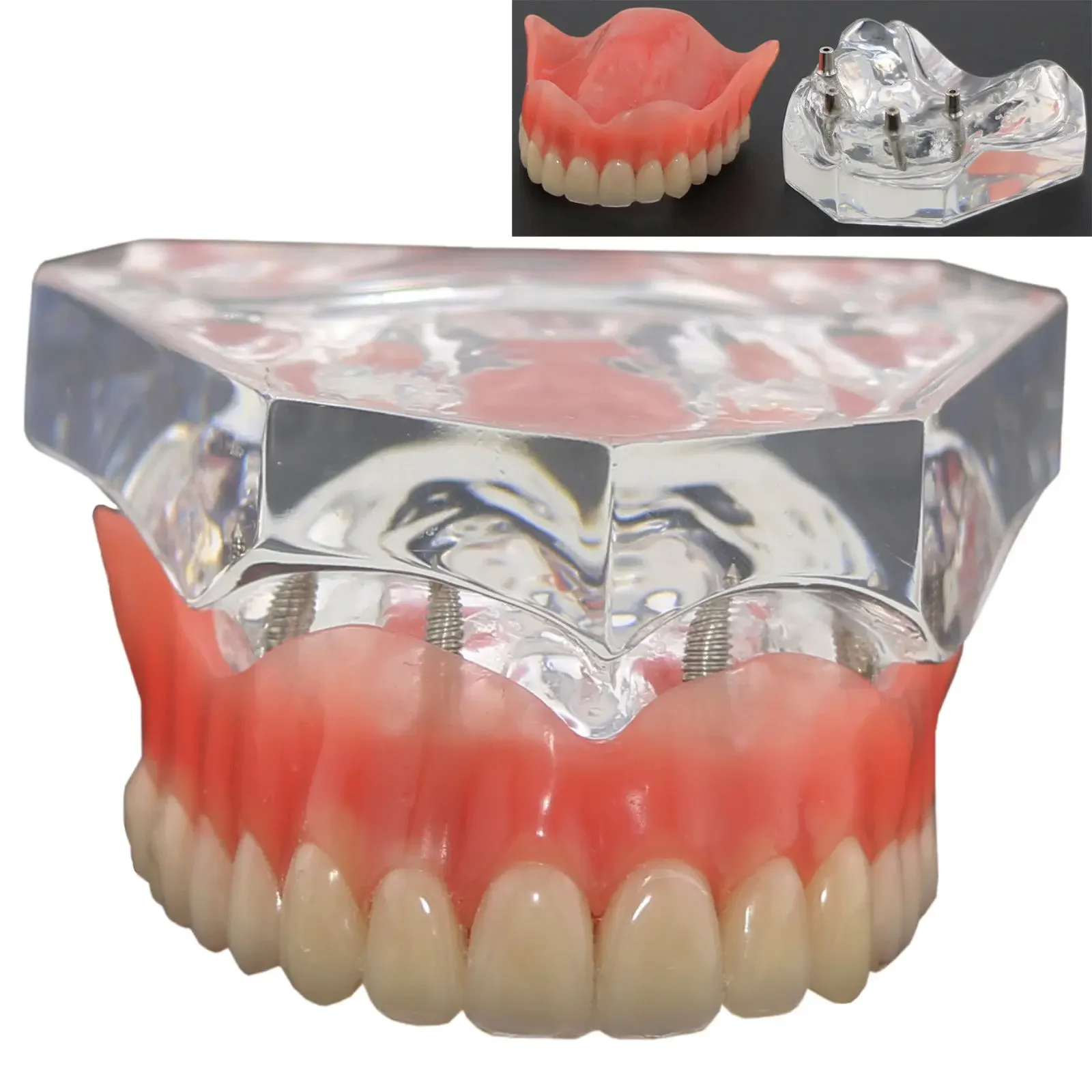 1pcs /pack Dental Upper Overdenture Superior 4 Implants Demo Model 6001 02 Teeth Model