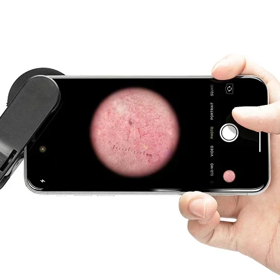 IBOOLO DE-300 Mini Dermatoscope High Quality Polarized And Non-Polarized Light Medical Optical Instrument