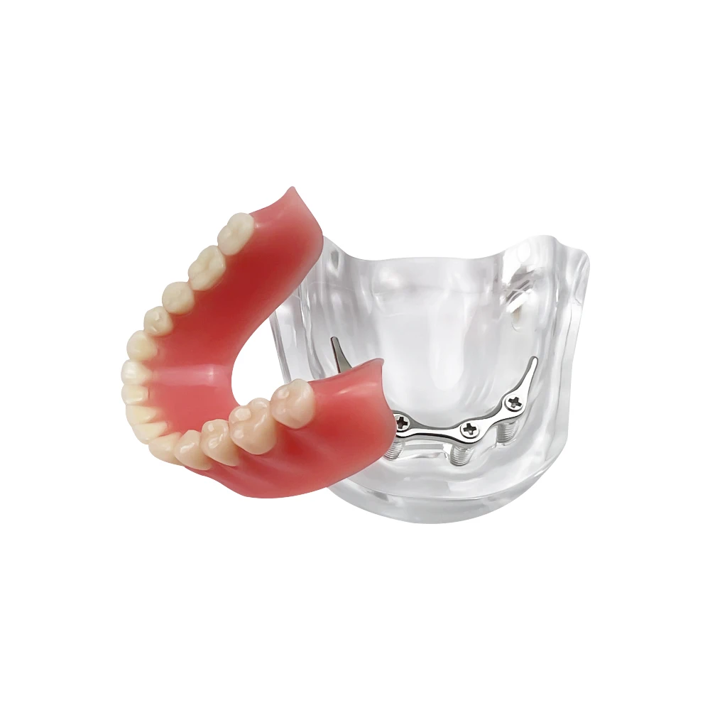Dental 4 Implants Teeth Model Silver/Gold Rod Type Clear Jaw Overdenture Restoration Model For Dentist Patient Communication