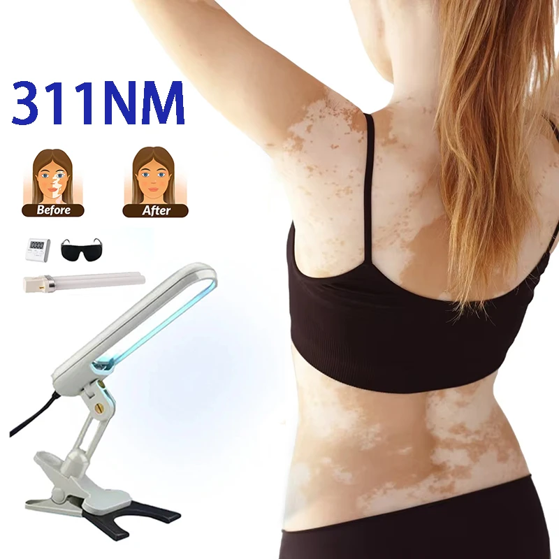 

Excimer Laser 318nm Psoriasis Vitiligo Laser Machine Uvb Lamps for Psoriasis Treatment Nb Uvb Lamp for Vitiligo