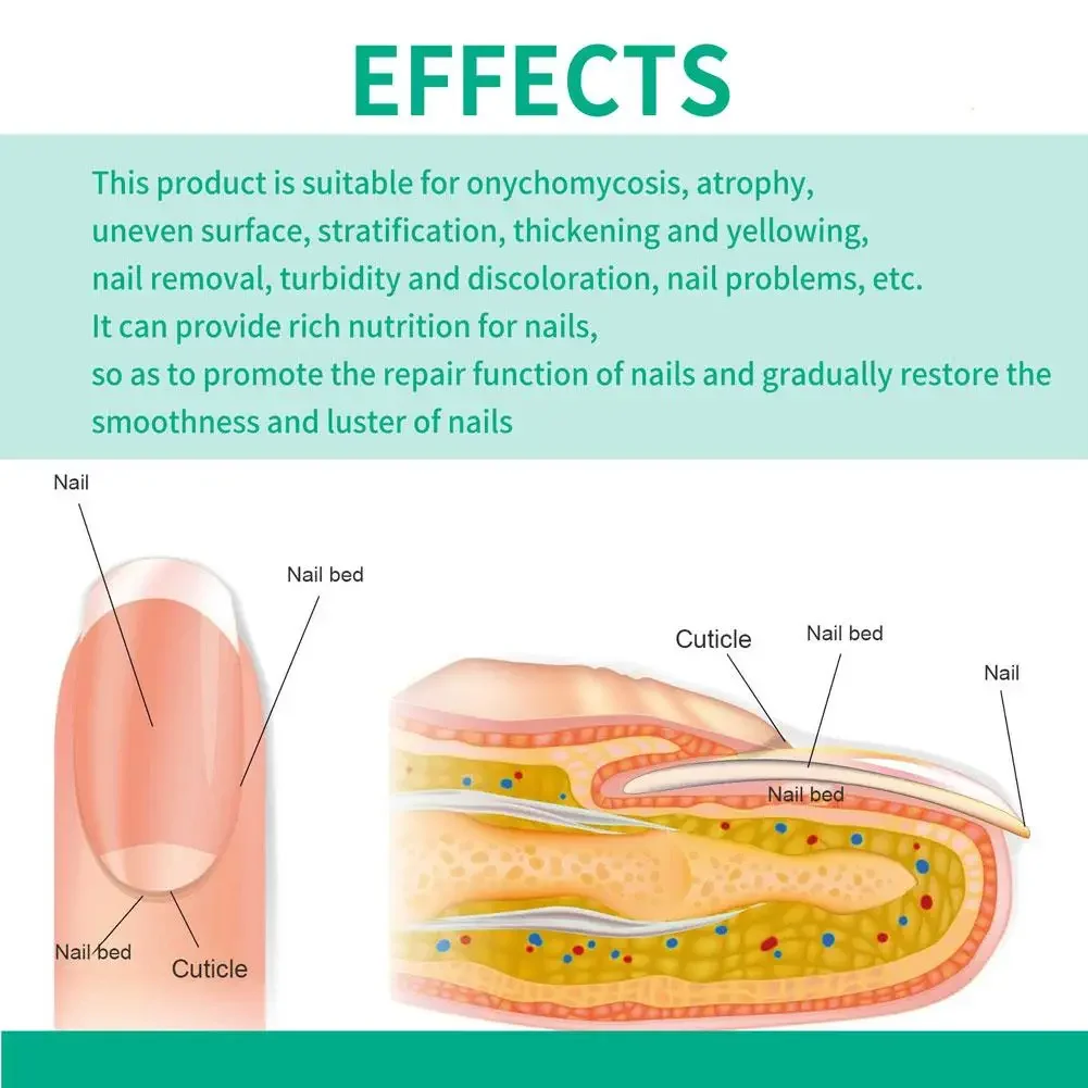 Traitement Antifongique des Ongles, Soins des Pieds, Essence Anti-betection, Paronyamitié, Onychomycose, Produits en Gel pour l'Élimination des Champignons