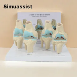 4-stage knee joint model Plastic Bone Model Pathological Knee Model Medical Teaching Model PVC Model