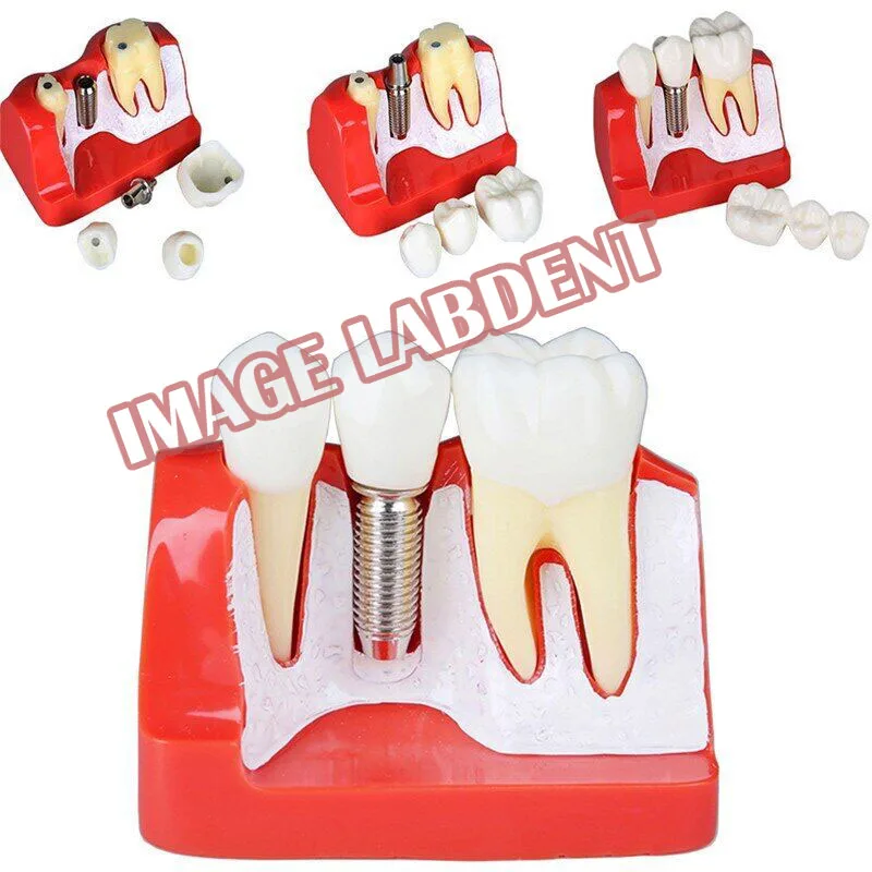 4 Times Dental Implant Teeth Model Teach Implant Analysis Crown Bridge Removable Model Dentist Teaching Demonstration Model