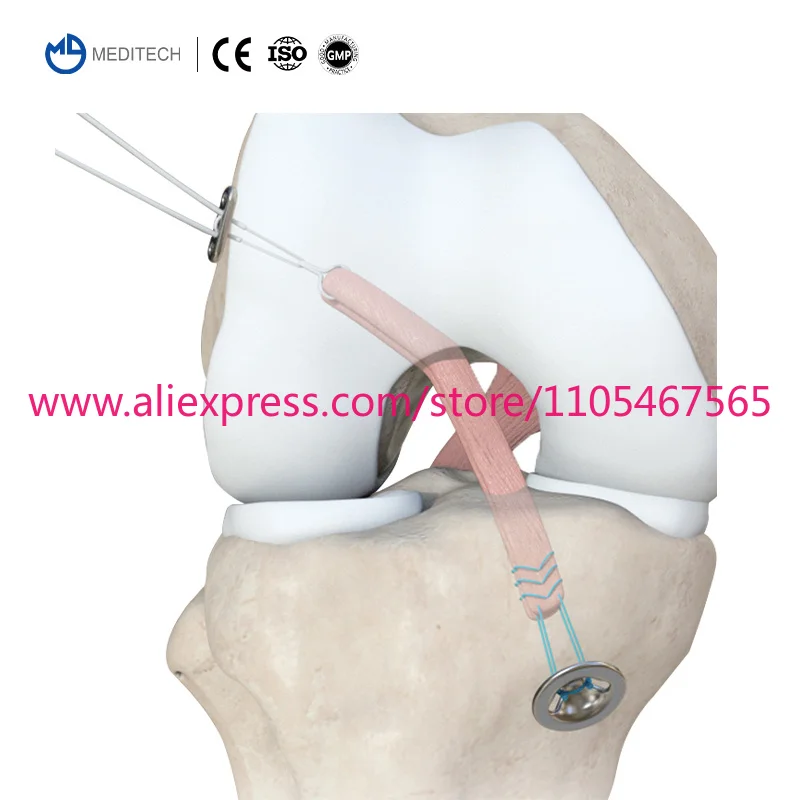 1PCS arthroscopic sports medicine fixed knotless button, with ring to hold the ACL inner button