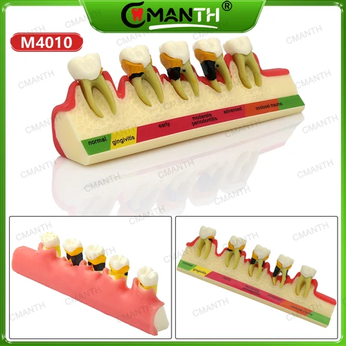 Imagen 2 del producto Modelo de enseñanza de dientes dentales, restauración, modelo de diente patológico, estudio de enseñanza Dental extraíble, demostración, entrenamiento de dentista