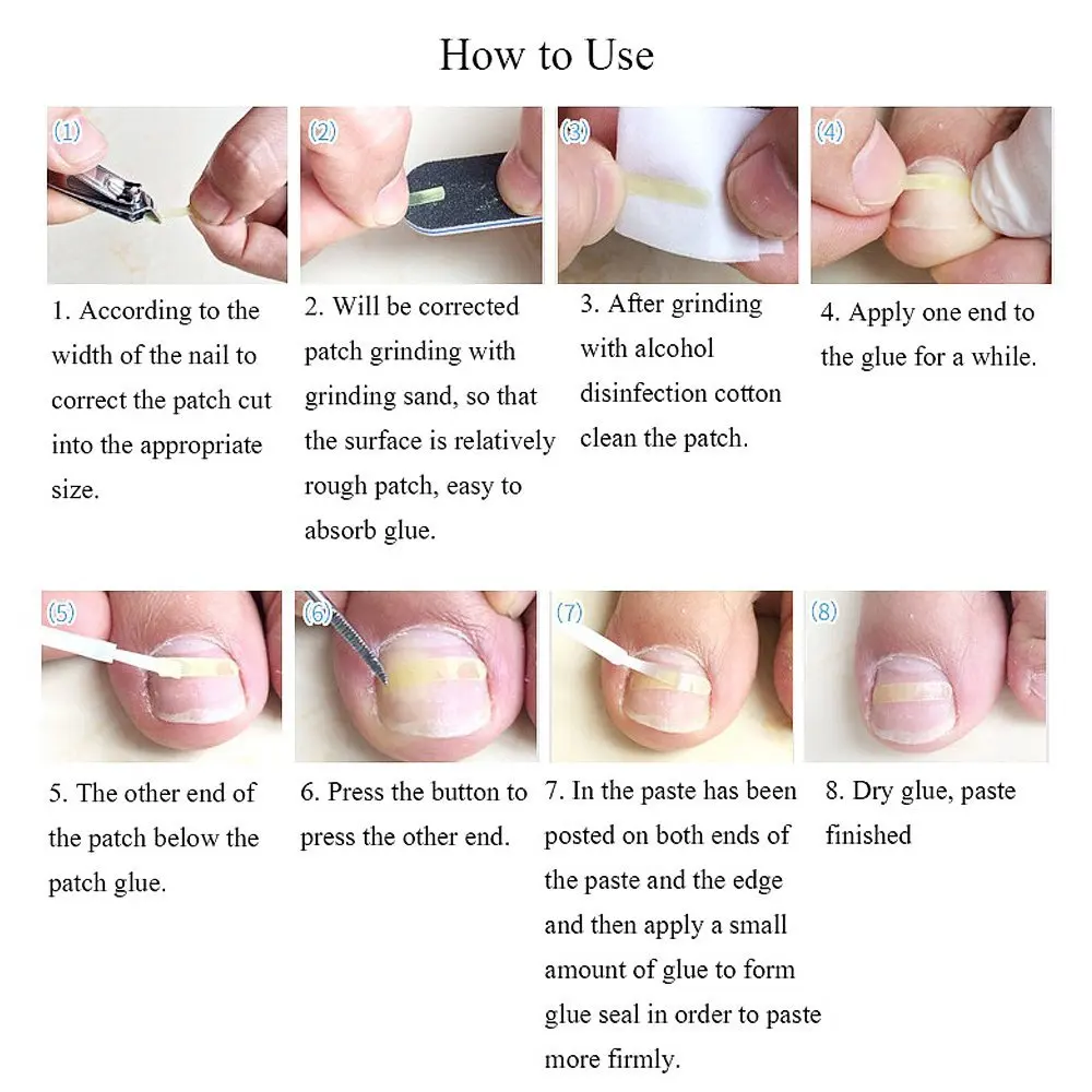 PARON-Outil de pédicure pour ongles incarnés, pince à redresser, attelle Bs incurvée, outil de paronyamitié optique, 10 pièces par bouteille