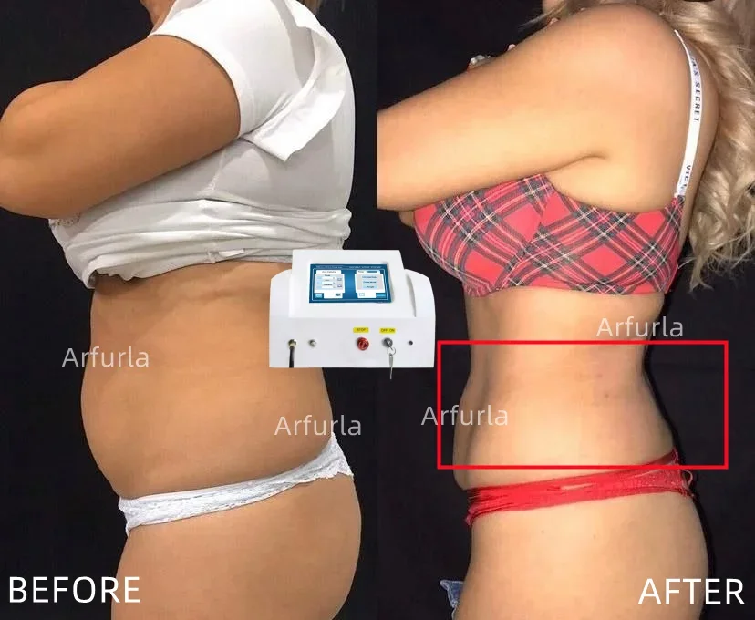 Fibra per lipolisi SMA 905 fibra di consumo medica 400um