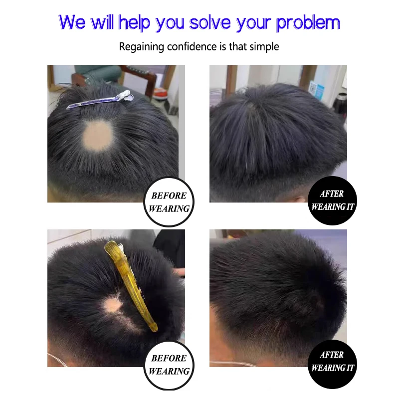 100% Human Hair Men's Circular Scar Patch Hairpiece Scar Toupee Invisible Seamless Ultra Thin Skin PU Suitable for Thinning Hair