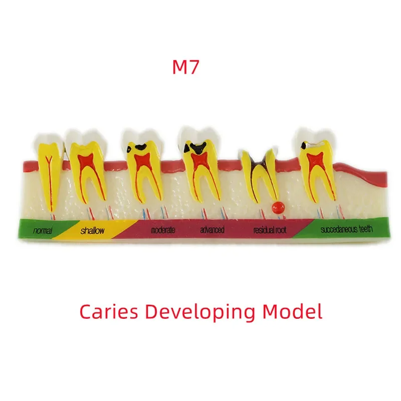 Dental Teaching Model Caries Developing Peridontal Diseases Different Periodontic Diseases Dentistry Accessories Laboratory Tool