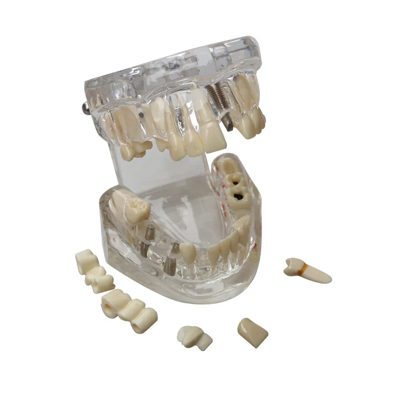 Dental implant explanation, oral teaching, doctor-patient communication model, comprehensive model, detachable