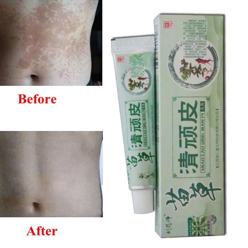 

Health psoriasis treatment cream Skin care Dermatitis Eczematoid Eczema Ointment eczema cream psoriasis Itching relief Ointment