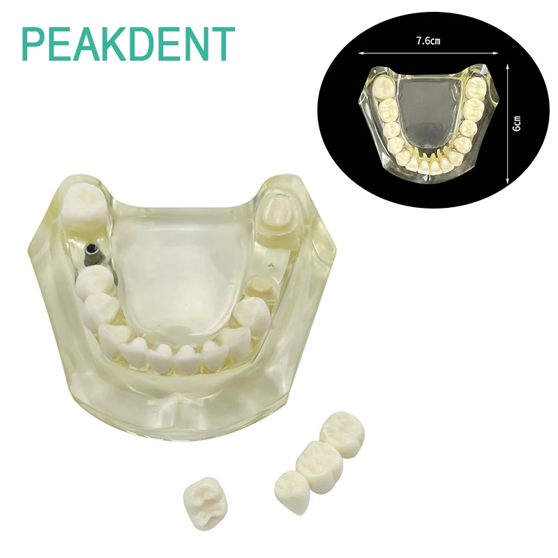 

Dental Implant Mandibular Model Removable Tooth Model Dental Training Demonstration