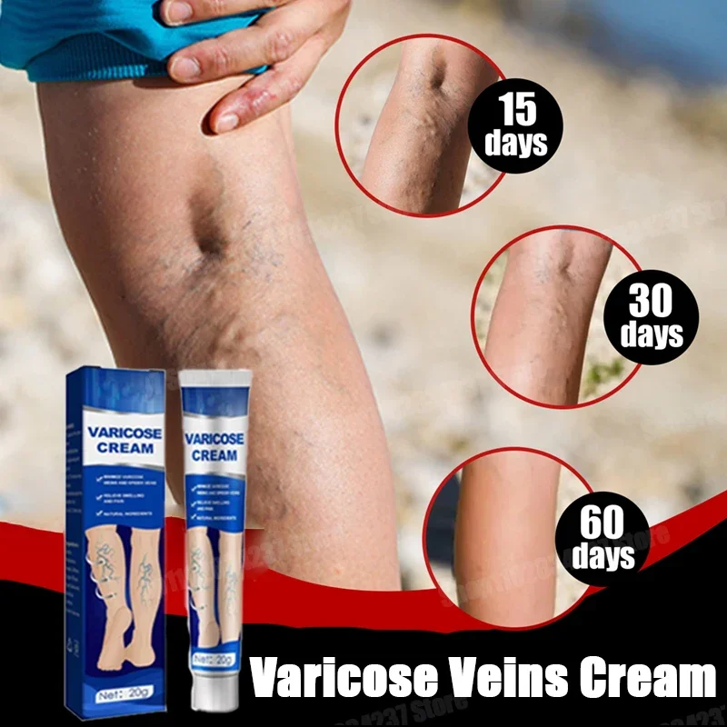 Varicose Veins Health Care Cream Leg Vasculitis Phlebitis Spider Shape Vein Pain Angiitis Removal Body Care